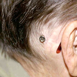 BAHA (Bone Anchored Hearing Aid)