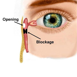 Dacryocystorhinostomy (DCR)