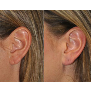 Earlobe Repair Surgical