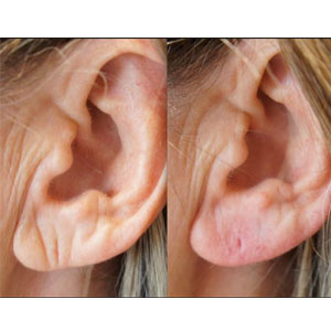 Ear Lobe Repair With Fillers
