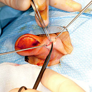 Endoscopic Ear Surgery