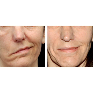 Facial Nerve Decompression