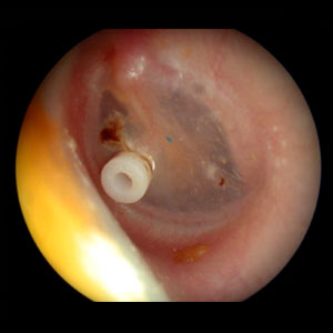 Myringotomy With Gromet Insertion