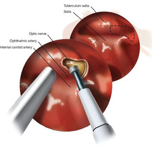 Optic Nerve Decompression