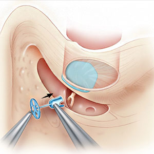 Ossiculoplasty