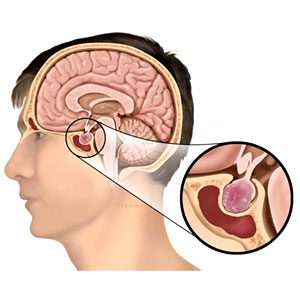 Pituitary Tumors