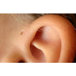 Pre Auricular Sinus