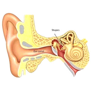 Otosclerosis