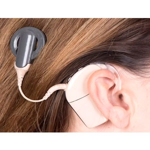 Vestibular Implant