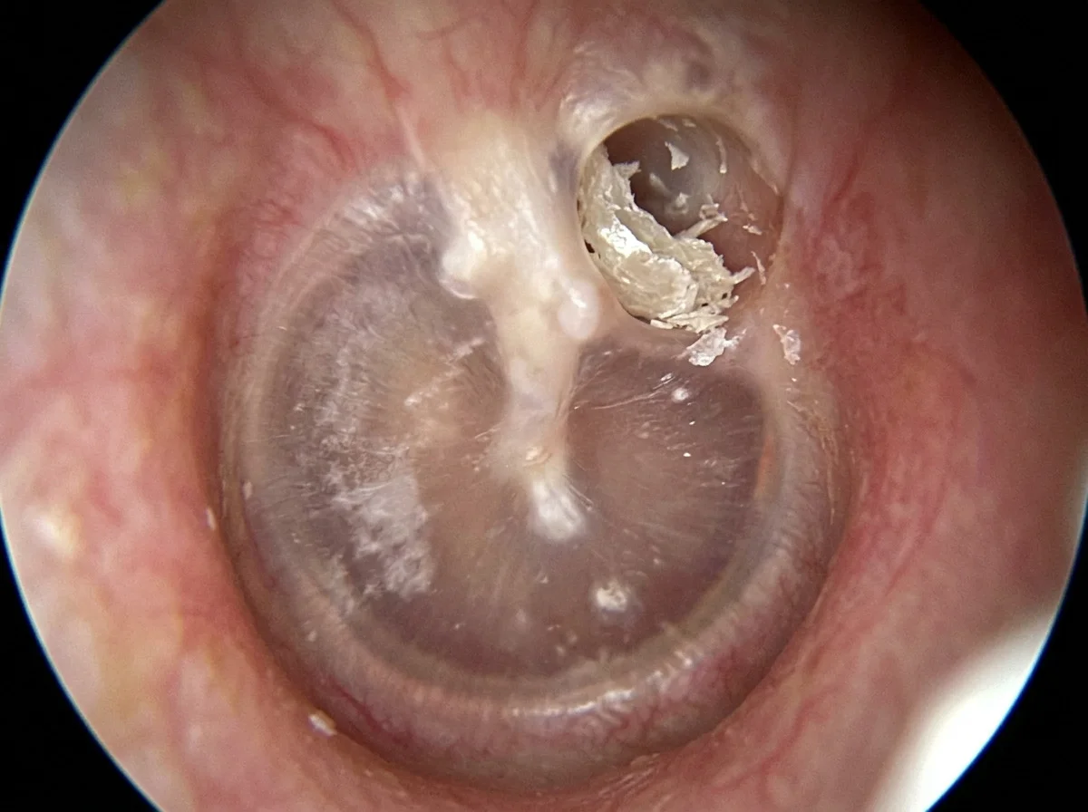 Pearly white skin debris in a pocket at the top of an eardrum, seen through an otoscope.