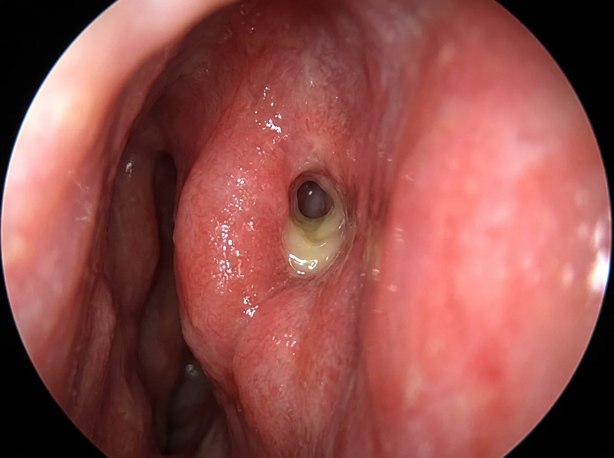 An endoscopic view of swollen sinus lining with a little thick mucus, and no blood.