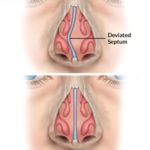 Septoplasty