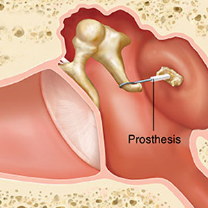 Middle Ear Prosthesis