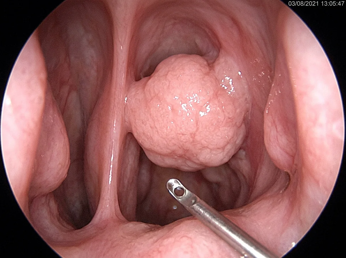 An endoscopic view of adenoid tissue behind the nose, with no child’s face.
