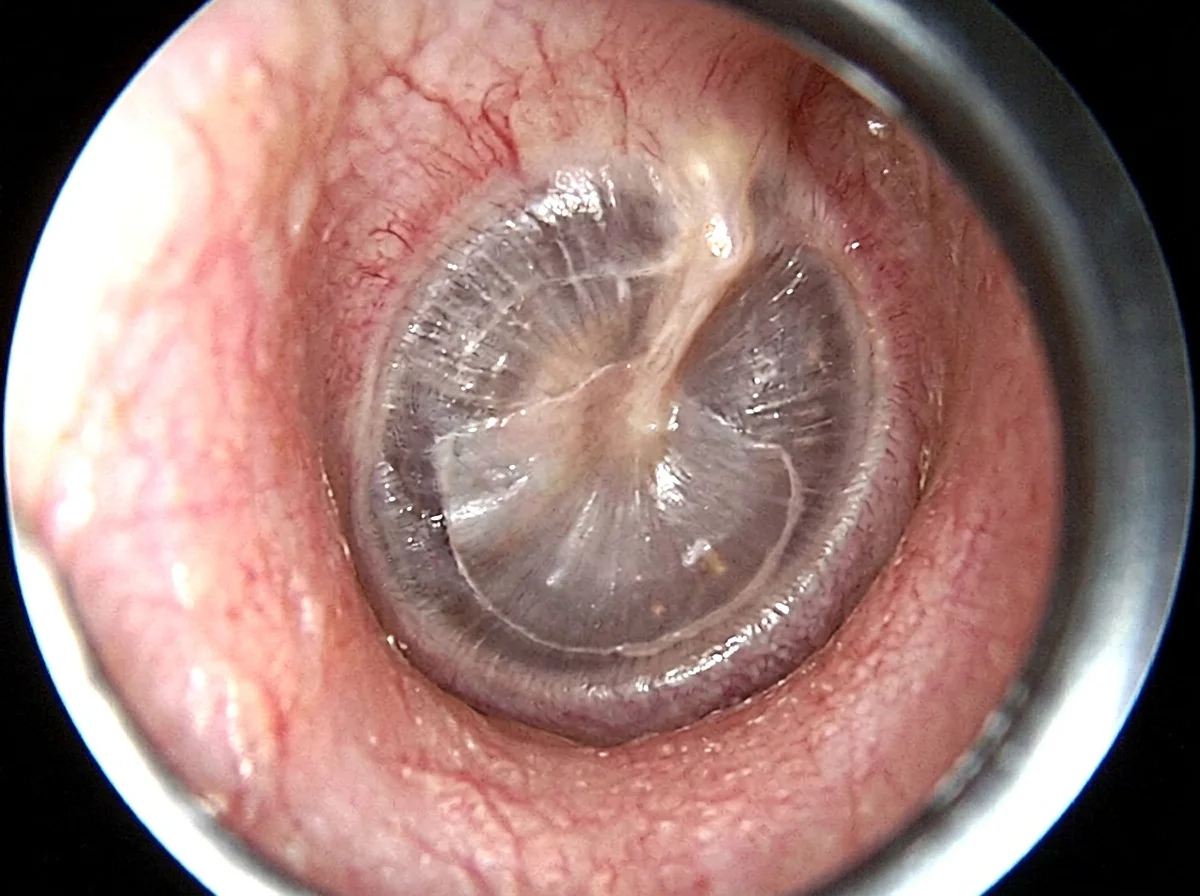 An eardrum closed by a thin graft, the hole no longer there, seen through an otoscope.