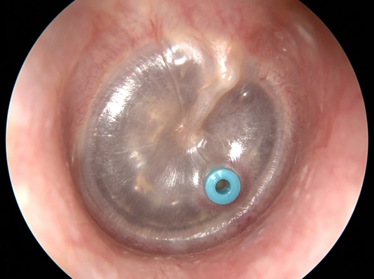A tiny ventilation tube sitting in an eardrum, seen through an otoscope.