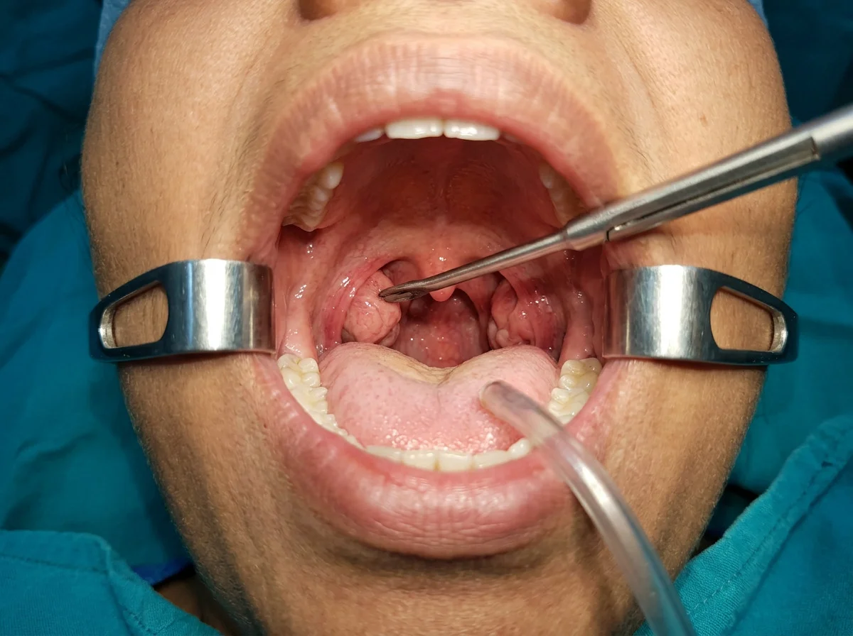 An adult mouth held open, tonsils visible, a surgical instrument in frame and no pool of blood.
